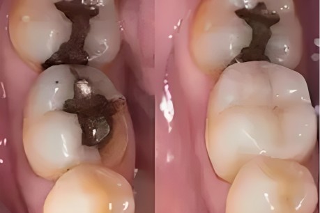 Metal Free Fillings - Healing Dentistry