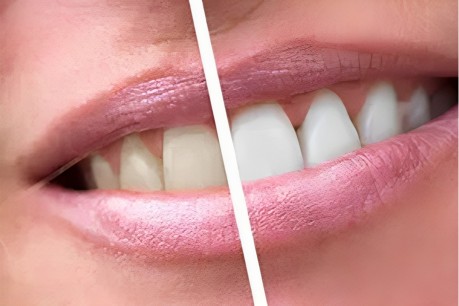 Teeth Whitening - Healing Dentistry